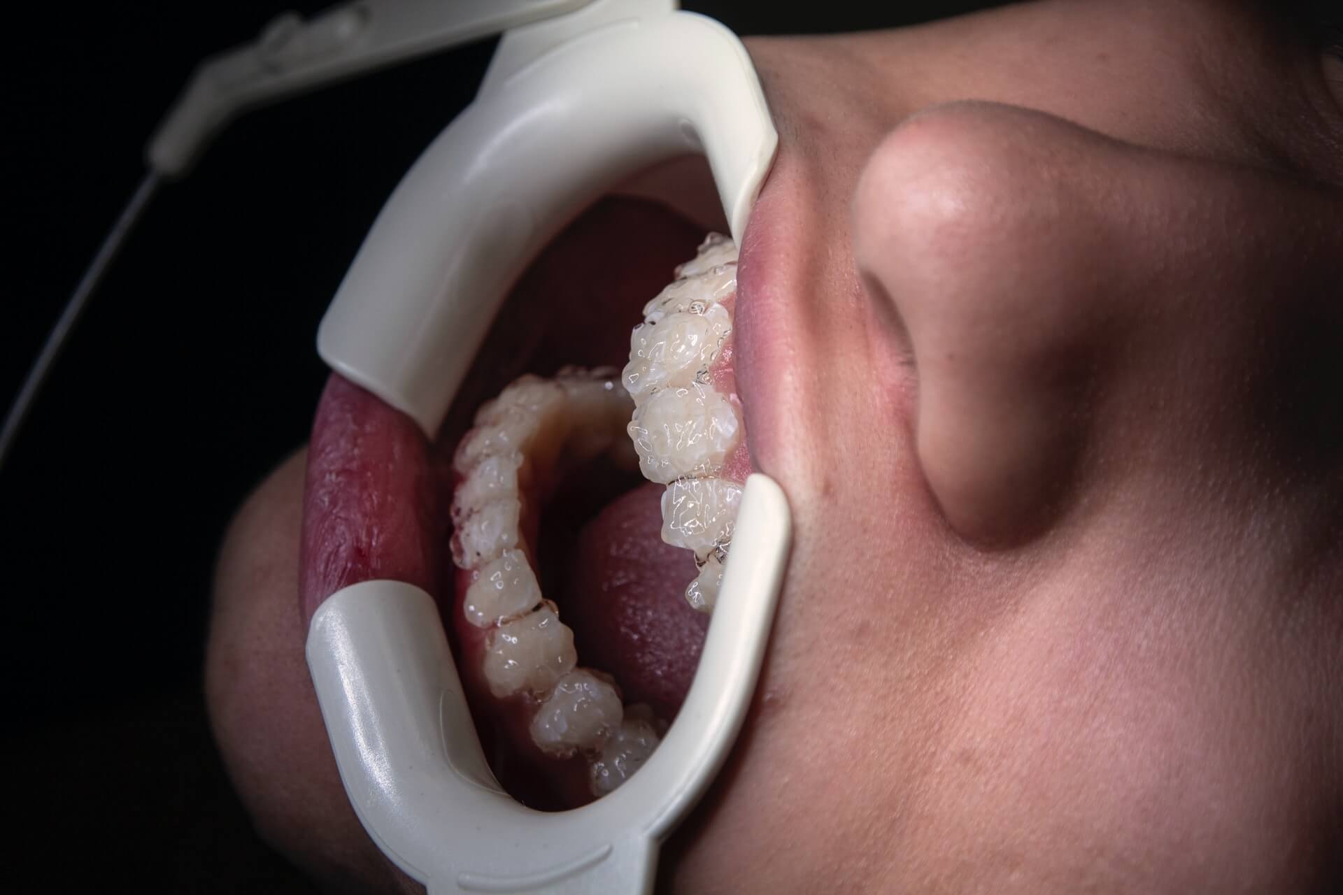 Cosmetic teeth whitening procedure at a dentist office