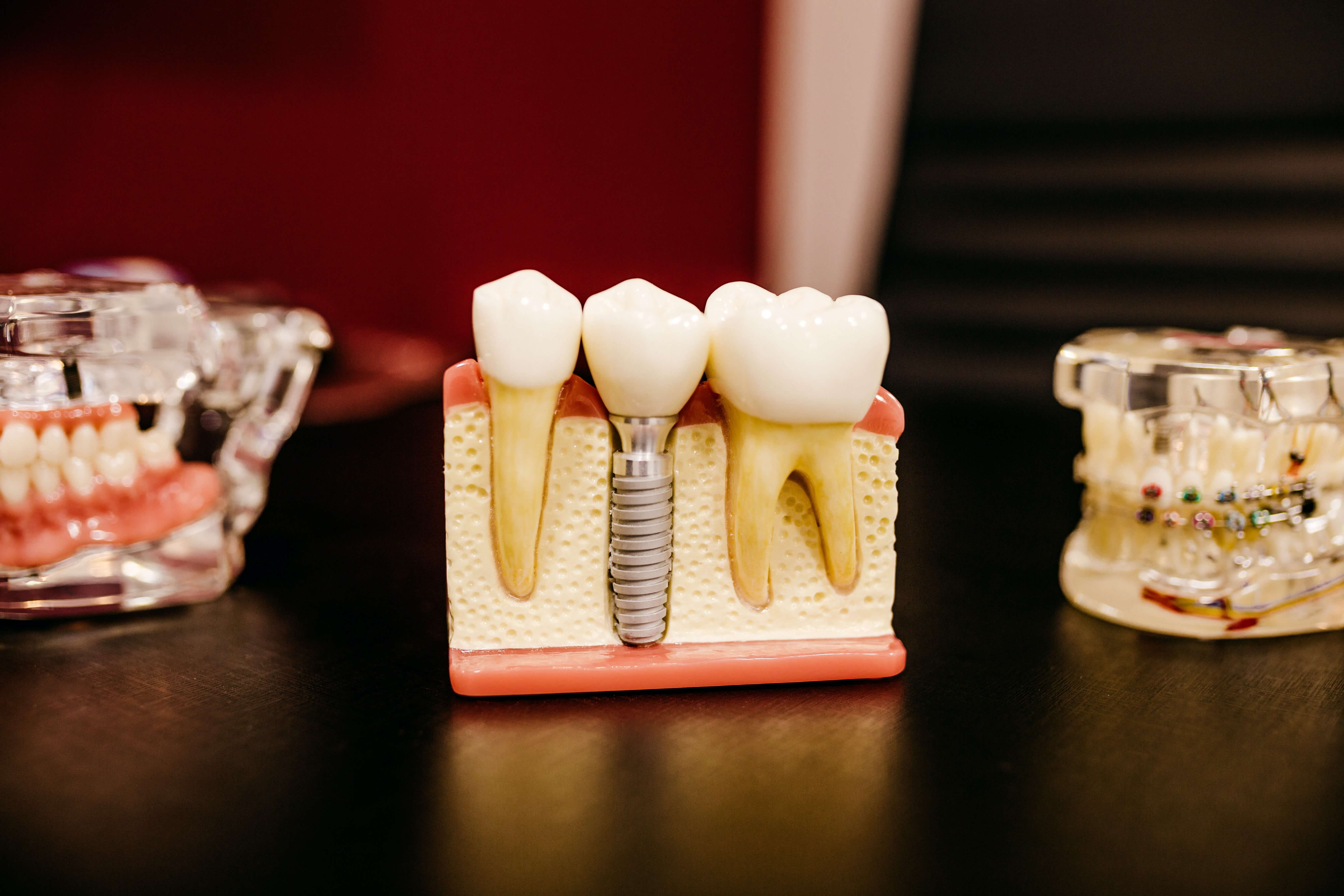 dental restorations and implants