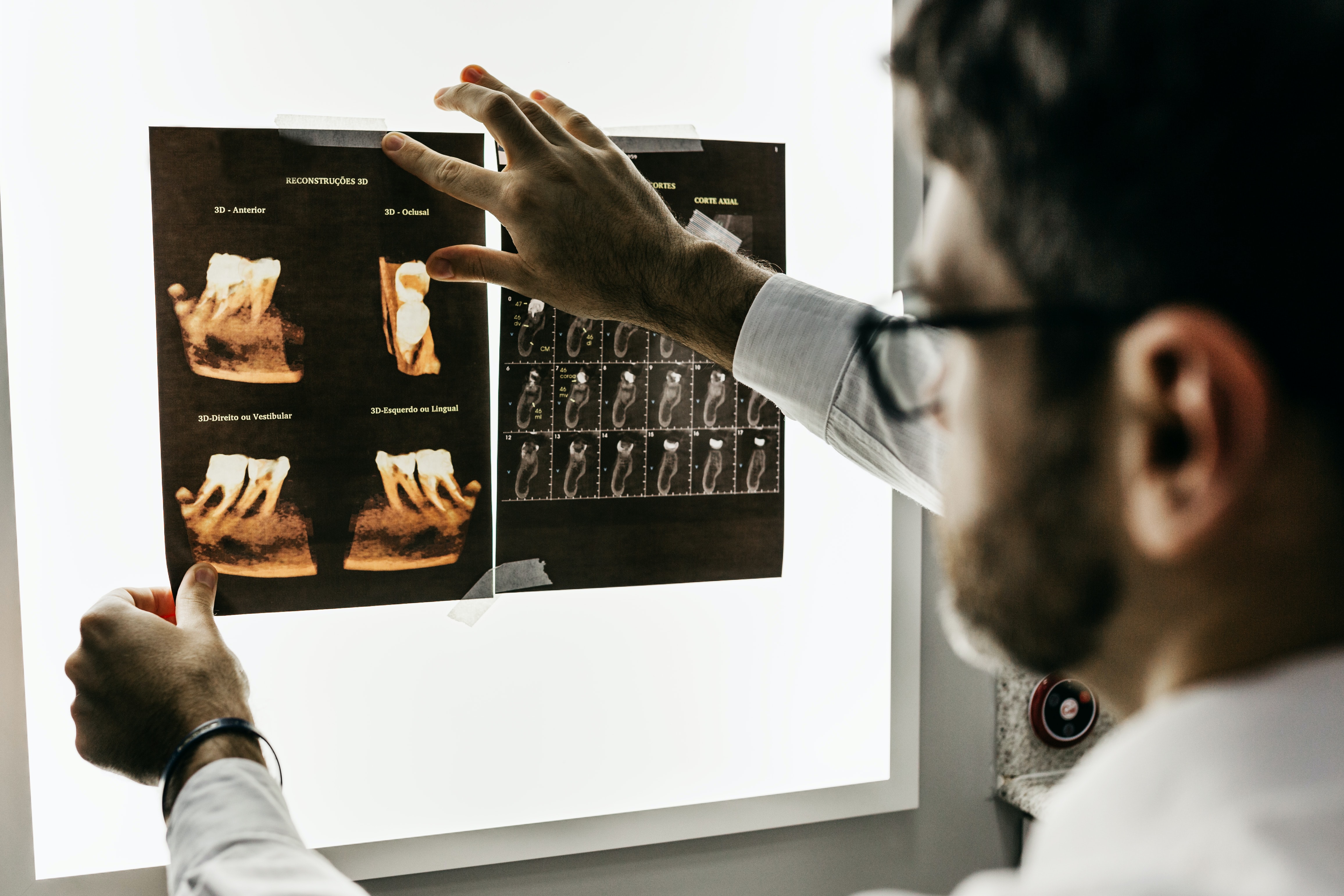 dentist holding up xrays of wisdom teeth on lightboard