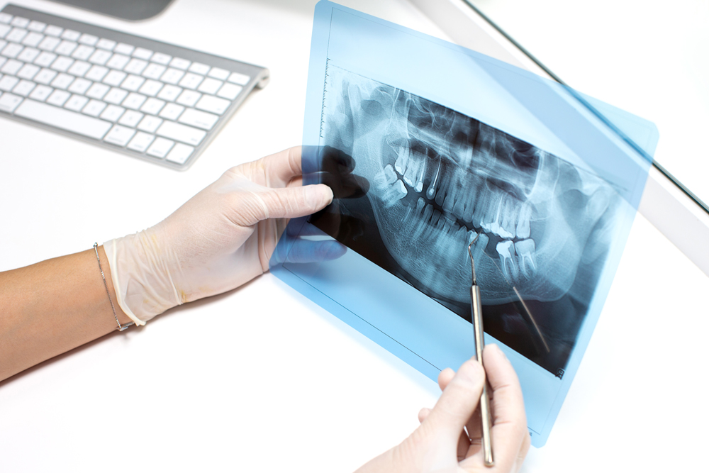 x ray of teeth lee simon dds smile makeover