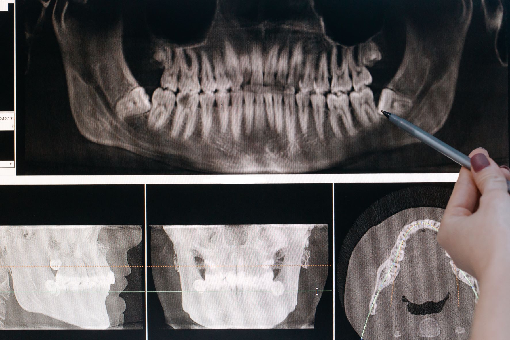 x-ray of teeth and roots used to determine a treatment plan. 