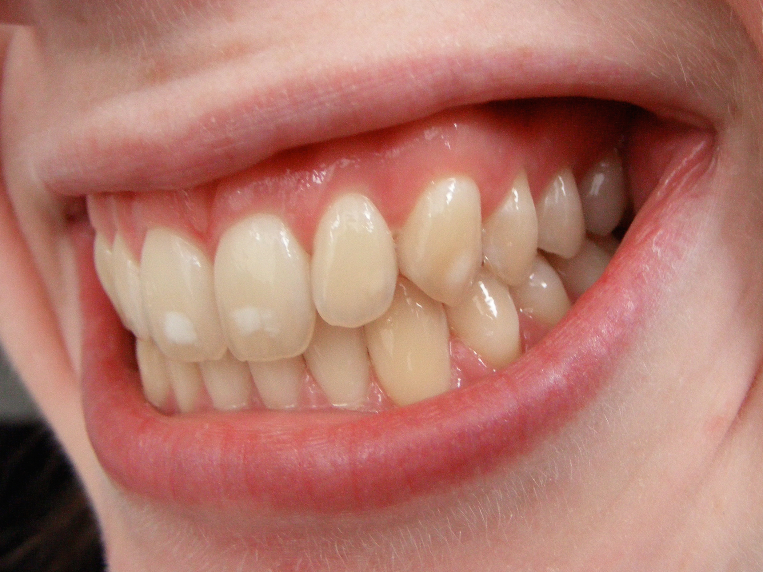 1560527864 dental fluorosis
